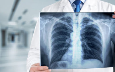 So erkennt der Lungenfacharzt ein Emphysem