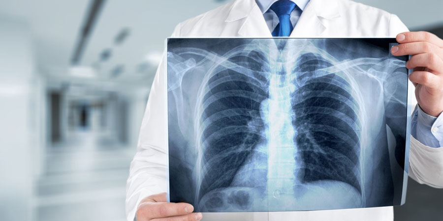 Arzt hält ein Röntgenbild der Lunge